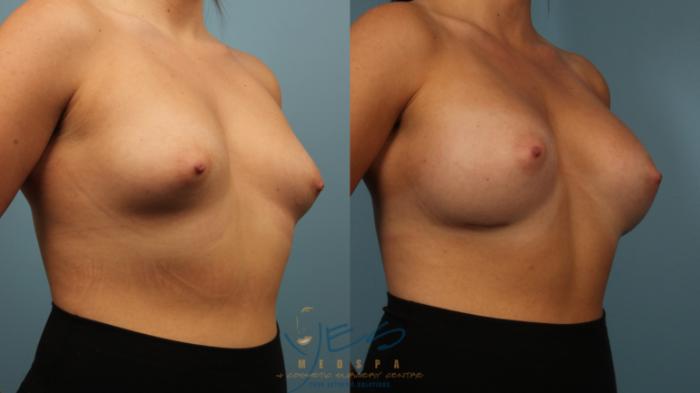Before & After Breast Augmentation Case 477 Right Oblique View in Vancouver, BC