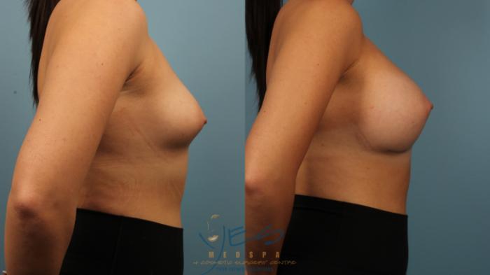 Before & After Breast Augmentation Case 477 Right Side View in Vancouver, BC