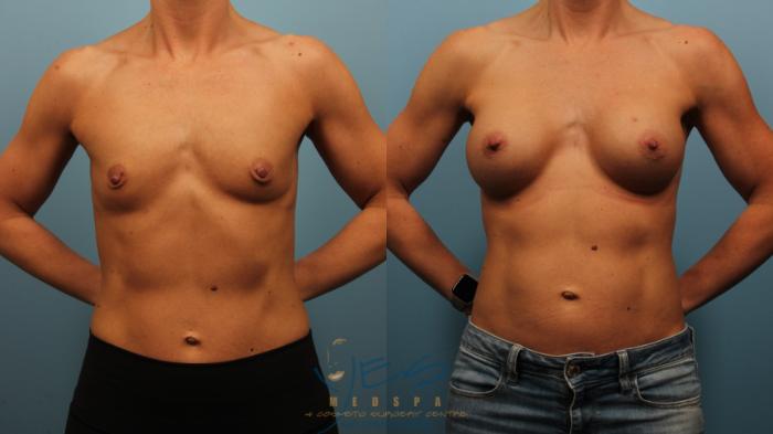 Before & After Breast Augmentation Case 479 Front View in Vancouver, BC