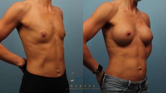 Before & After Breast Augmentation Case 479 Right Oblique View in Vancouver, BC