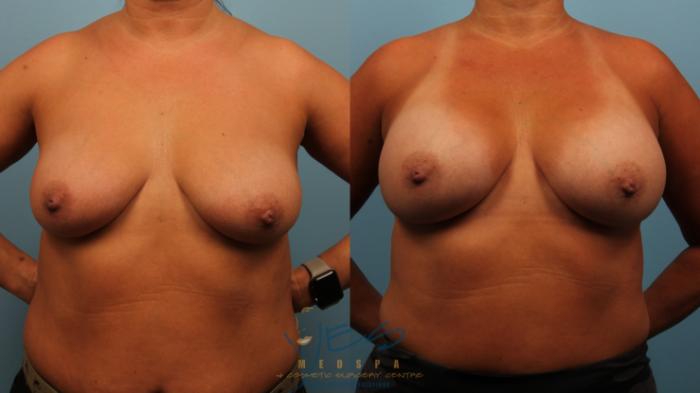 Before & After Breast Augmentation Case 481 Front View in Vancouver, BC