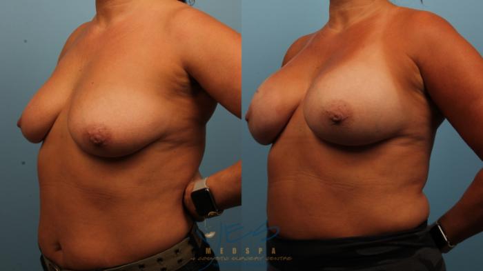 Before & After Breast Augmentation Case 481 Left Oblique View in Vancouver, BC