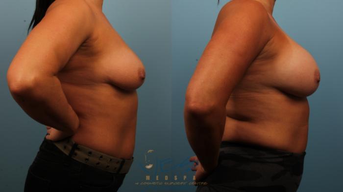Before & After Breast Augmentation Case 481 Right Side View in Vancouver, BC