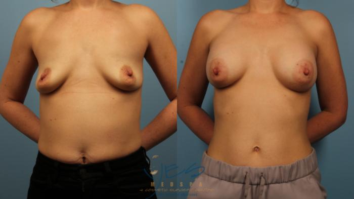 Before & After Breast Augmentation Case 482 Front View in Vancouver, BC