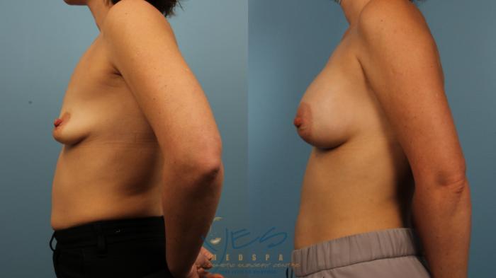 Before & After Breast Augmentation Case 482 Left Side View in Vancouver, BC