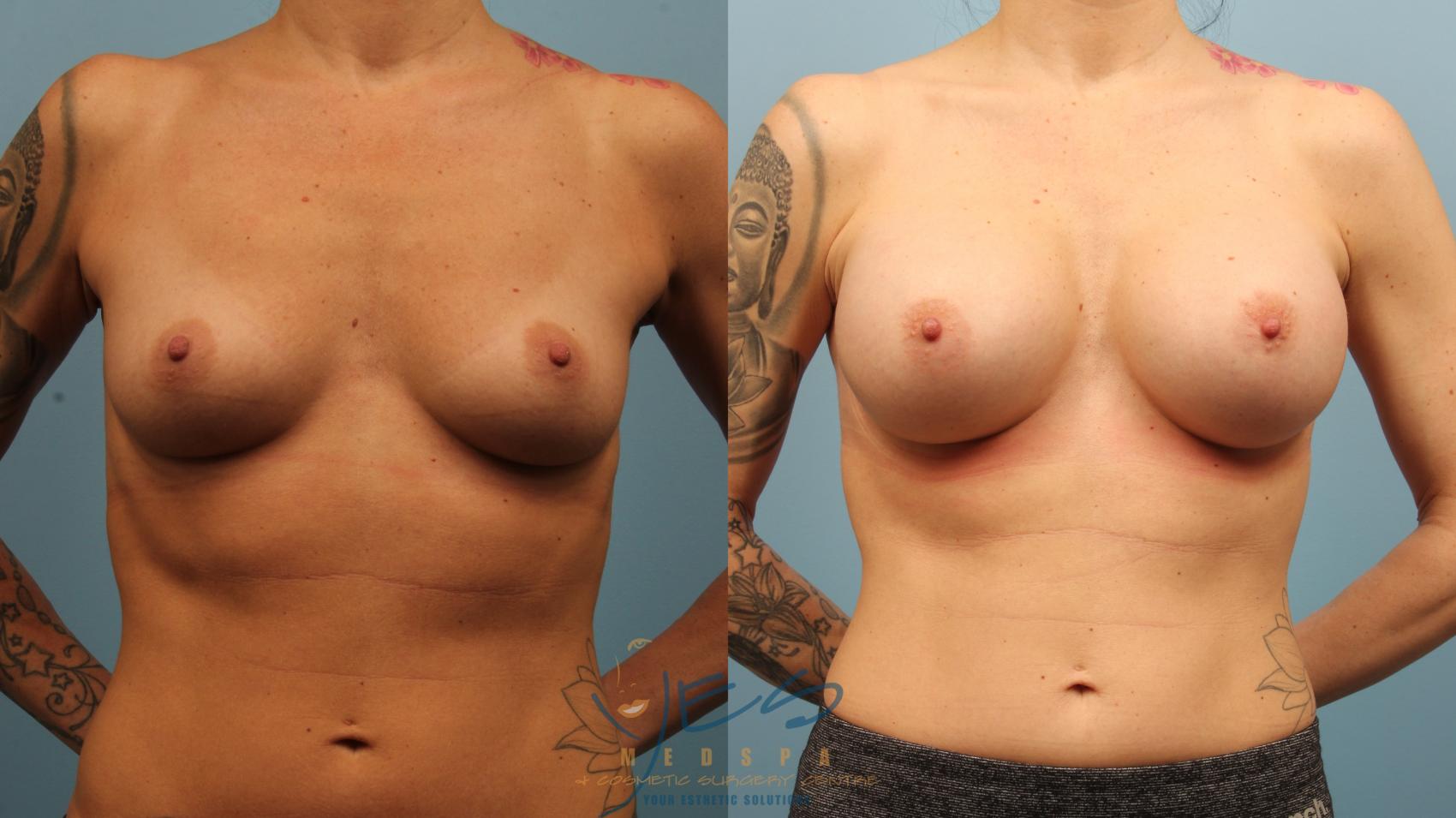 Before & After Breast Augmentation Case 483 Front View in Vancouver, BC