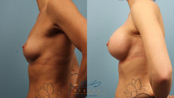 Before & After Breast Augmentation Case 483 Left Side View in Vancouver, BC