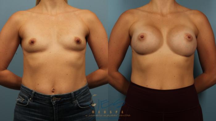 Before & After Breast Augmentation Case 484 Front View in Vancouver, BC