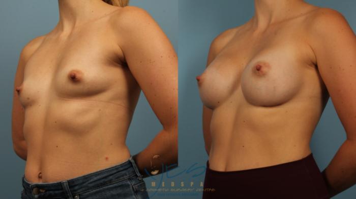 Before & After Breast Augmentation Case 484 Left Oblique View in Vancouver, BC