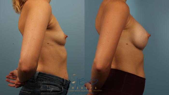 Before & After Breast Augmentation Case 484 Right Side View in Vancouver, BC
