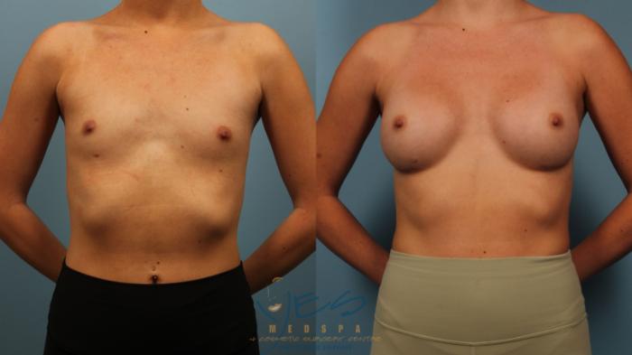 Before & After Breast Augmentation Case 485 Front View in Vancouver, BC