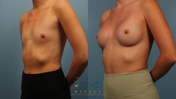 Before & After Breast Augmentation Case 485 Left Oblique View in Vancouver, BC