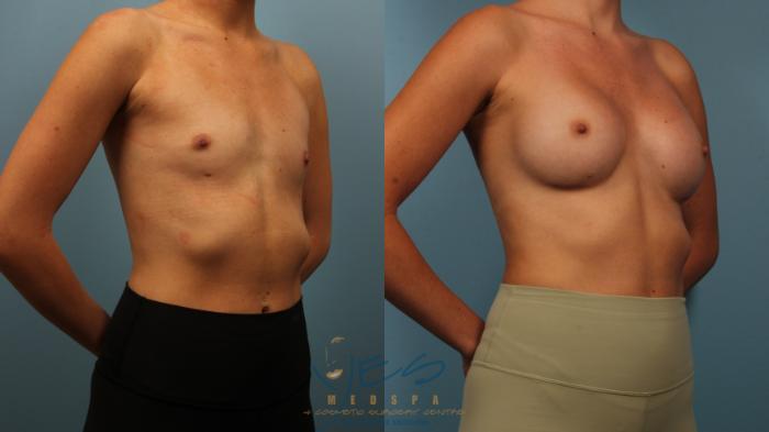 Before & After Breast Augmentation Case 485 Right Oblique View in Vancouver, BC