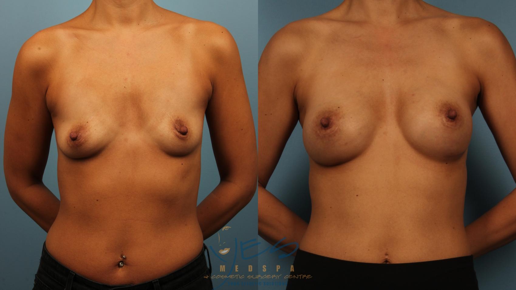 Before & After Breast Augmentation Case 486 Front View in Vancouver, BC