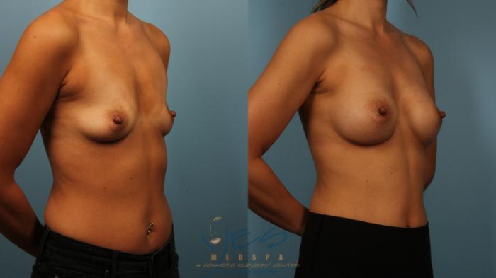 Before & After Breast Augmentation Case 486 Right Oblique View in Vancouver, BC