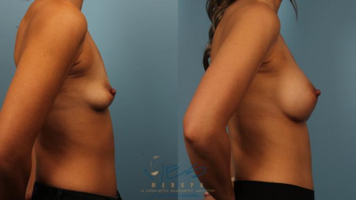 Before & After Breast Augmentation Case 486 Right Side View in Vancouver, BC