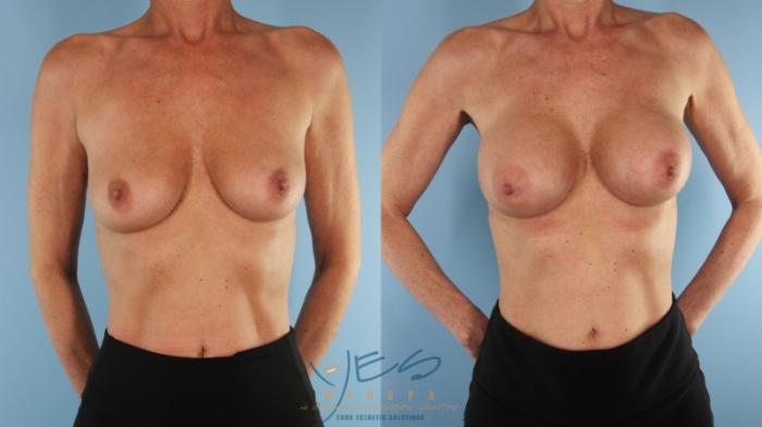 Before & After Breast Augmentation Case 489 Front View in Vancouver, BC