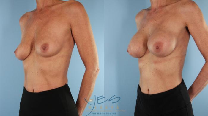Before & After Breast Augmentation Case 489 Right Oblique View in Vancouver, BC