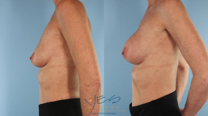 Before & After Breast Augmentation Case 489 Right Side View in Vancouver, BC