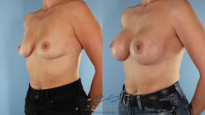 Before & After Breast Augmentation Case 490 Right Oblique View in Vancouver, BC
