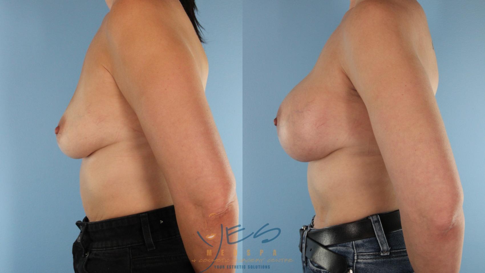 Before & After Breast Augmentation Case 490 Right Side View in Vancouver, BC