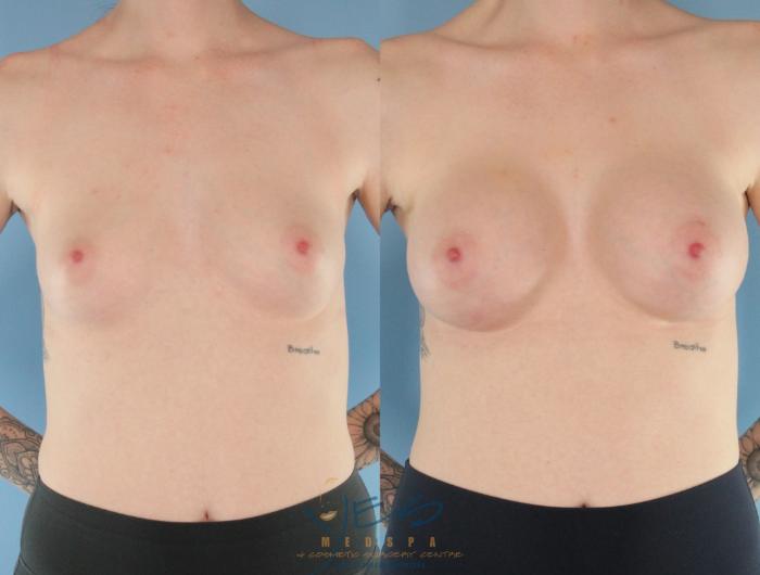 Before & After Breast Augmentation Case 494 Front View in Vancouver, BC