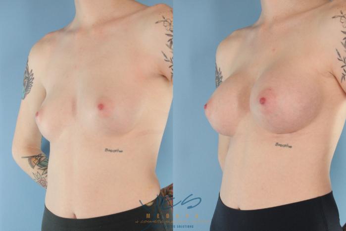 Before & After Breast Augmentation Case 494 Left Oblique View in Vancouver, BC