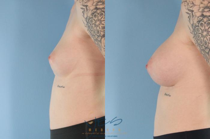 Before & After Breast Augmentation Case 494 Left Side View in Vancouver, BC