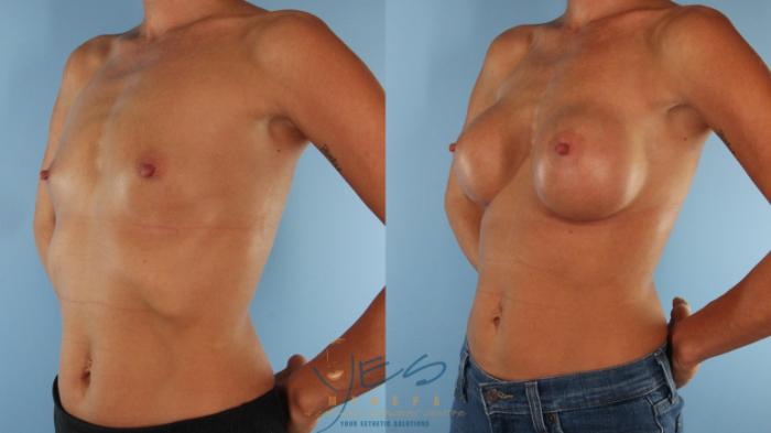 Before & After Breast Augmentation Case 495 Left Oblique View in Vancouver, BC