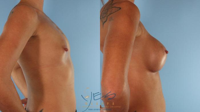 Before & After Breast Augmentation Case 495 Right Side View in Vancouver, BC