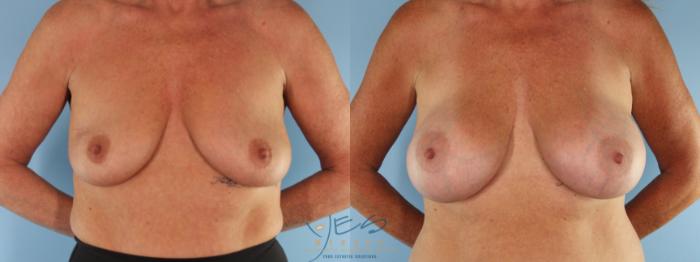 Before & After Breast Augmentation Case 496 Front View in Vancouver, BC