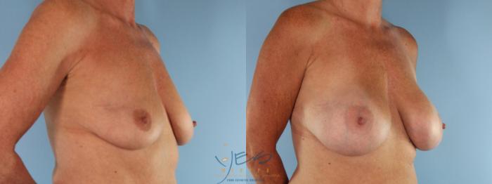 Before & After Breast Augmentation Case 496 Left Oblique View in Vancouver, BC