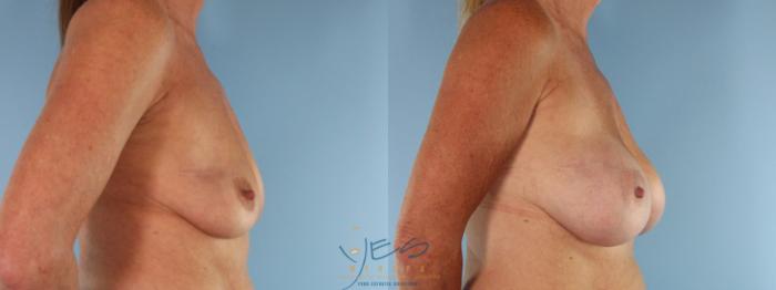 Before & After Breast Augmentation Case 496 Left Side View in Vancouver, BC