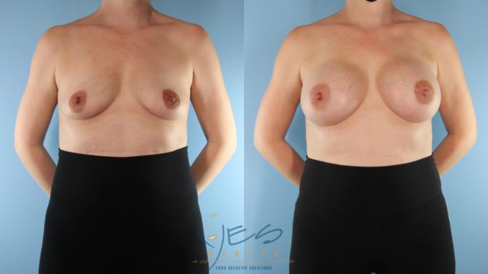 Before & After Breast Augmentation Case 504 Front View in Vancouver, BC