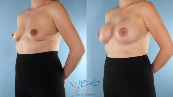Before & After Breast Augmentation Case 504 Left Oblique View in Vancouver, BC