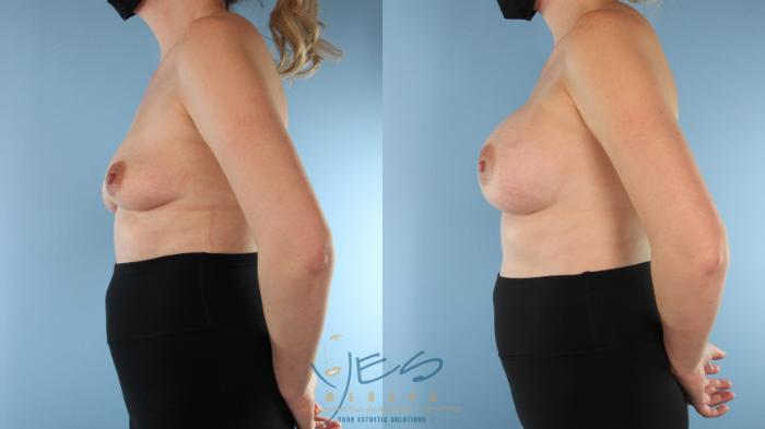 Before & After Breast Augmentation Case 504 Left Side View in Vancouver, BC