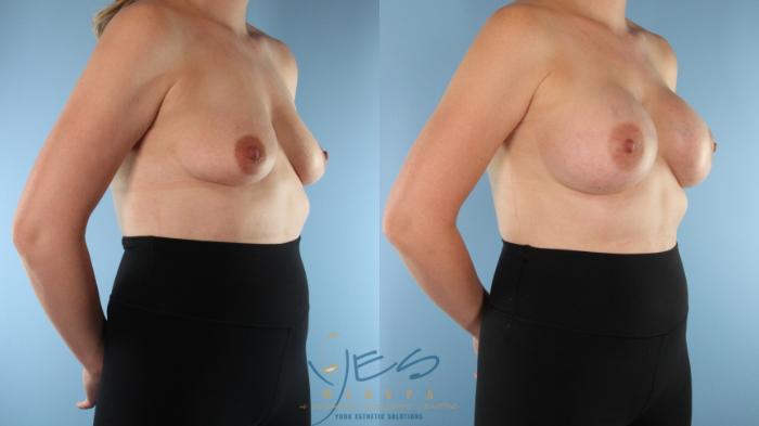 Before & After Breast Augmentation Case 504 Right Oblique View in Vancouver, BC