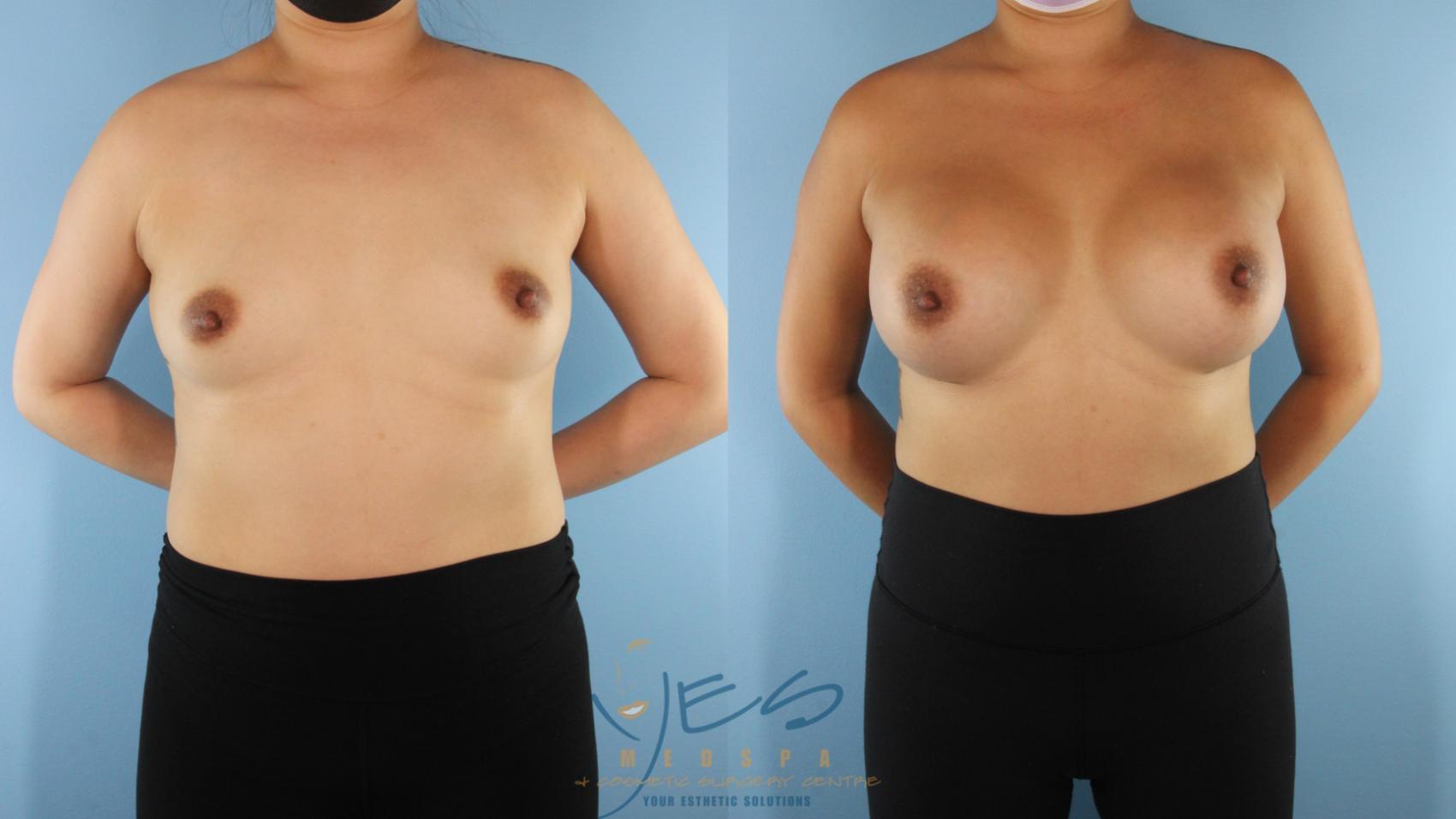 Before & After Breast Augmentation Case 511 Front View in Vancouver, BC