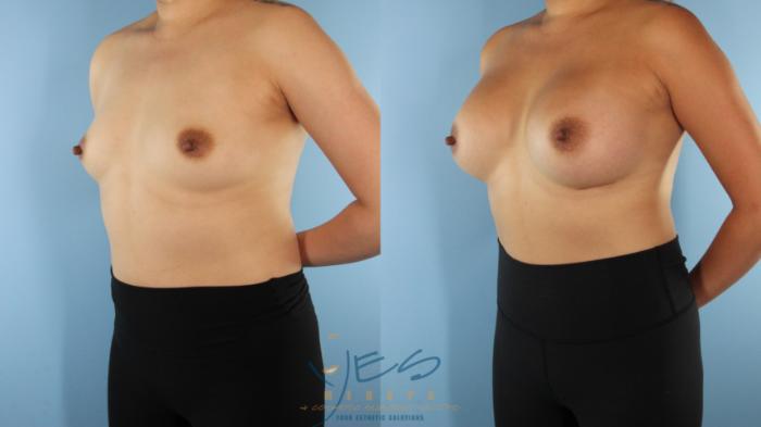 Before & After Breast Augmentation Case 511 Left Oblique View in Vancouver, BC
