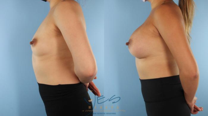 Before & After Breast Augmentation Case 511 Left Side View in Vancouver, BC