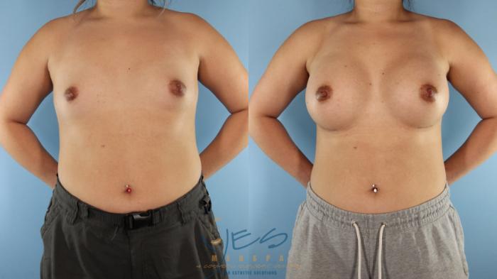 Before & After Breast Augmentation Case 512 Front View in Vancouver, BC