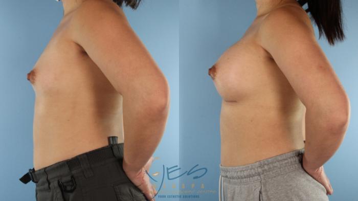 Before & After Breast Augmentation Case 512 Left Side View in Vancouver, BC