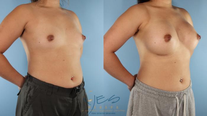 Before & After Breast Augmentation Case 512 Right Oblique View in Vancouver, BC