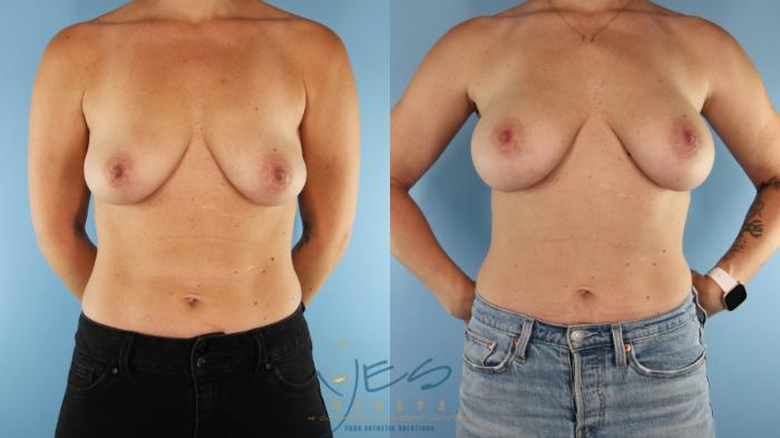 Before & After Breast Augmentation Case 514 Front View in Vancouver, BC