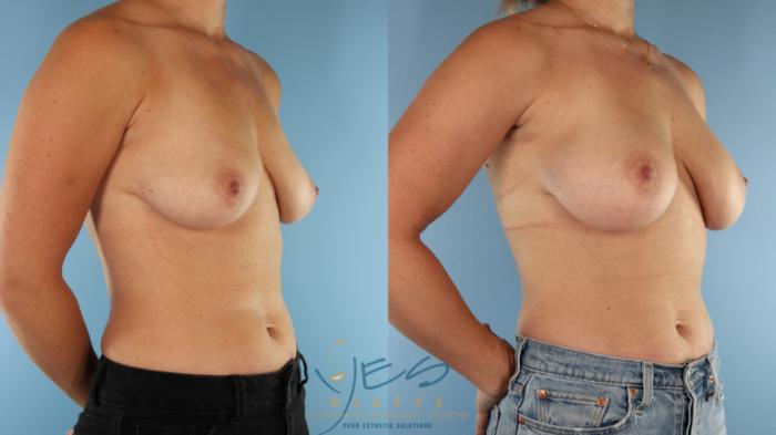 Before & After Breast Augmentation Case 514 Left Oblique View in Vancouver, BC