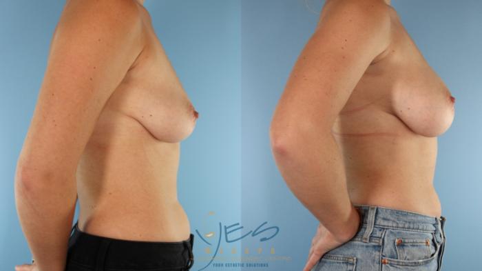 Before & After Breast Augmentation Case 514 Right Side View in Vancouver, BC