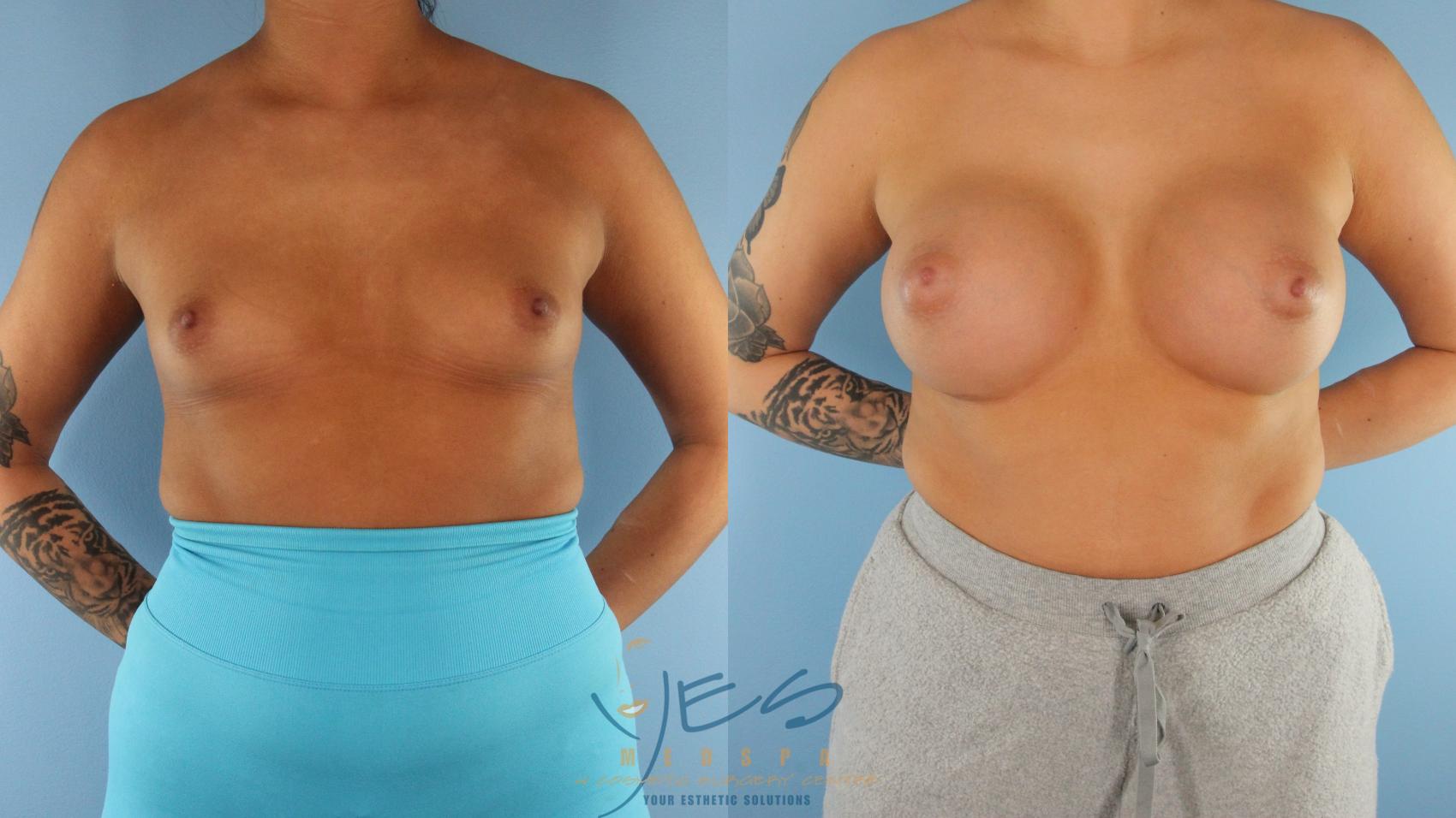 Before & After Breast Augmentation Case 515 Front View in Vancouver, BC