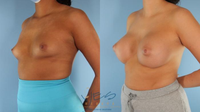 Before & After Breast Augmentation Case 515 Left Oblique View in Vancouver, BC