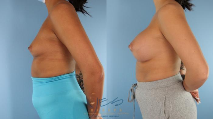 Before & After Breast Augmentation Case 515 Left Side View in Vancouver, BC