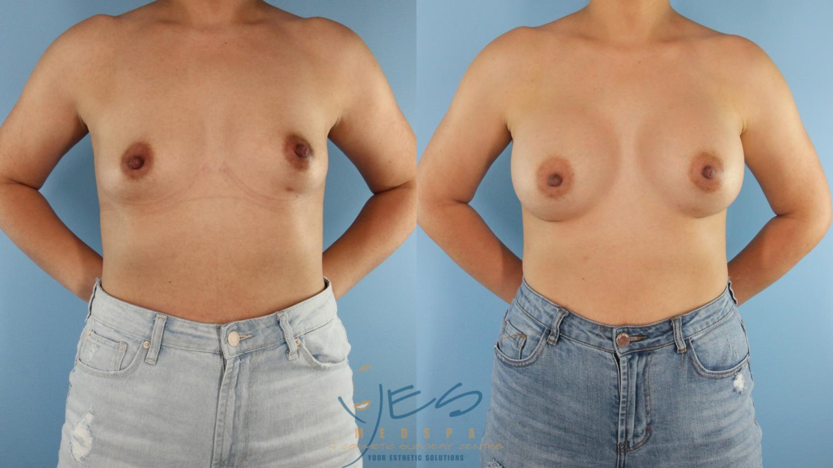 Before & After Breast Augmentation Case 516 Front View in Vancouver, BC